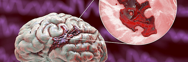 Multi-pay Critical Illness Products in Asia